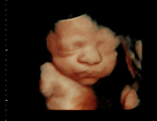 3D ultrasound image at 29 weeks